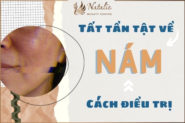 Nám da là gì? Cách điều trị nám da hiệu quả