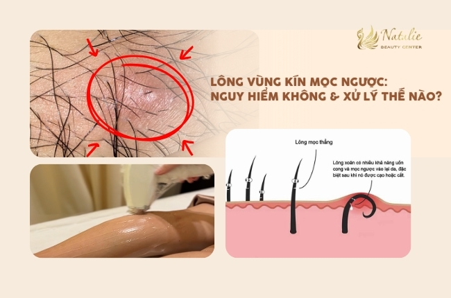 Lông vùng kín mọc ngược: Có nguy hiểm không và xử lý thế nào?