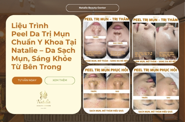 Liệu Trình Peel Da Trị Mụn Chuẩn Y Khoa Tại Natalie – Da Sạch Mụn, Sáng Khỏe Từ Bên Trong