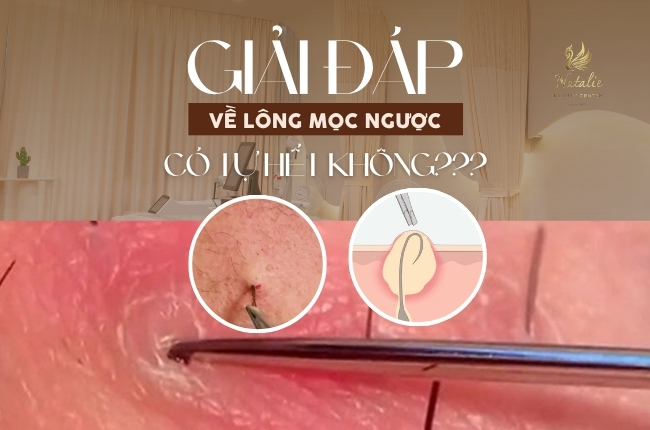 Lông mọc ngược có tự hết không? Bật mí cách chăm da đúng để tránh lông mọc ngược