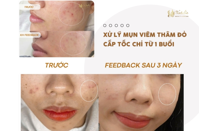 Xử Lý Mụn Viêm Thâm Đỏ Cấp Tốc Chỉ Từ Một Buổi