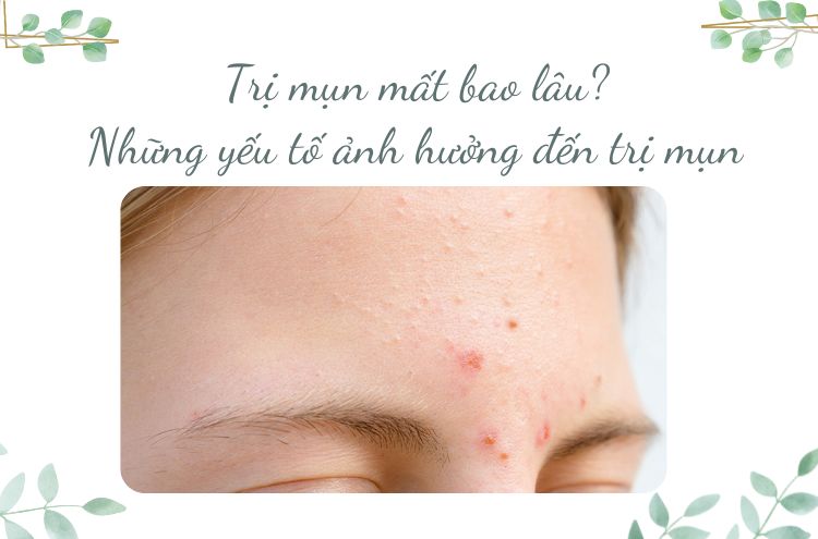 Trị mụn mất bao lâu? Những yếu tố ảnh hưởng đến trị mụn