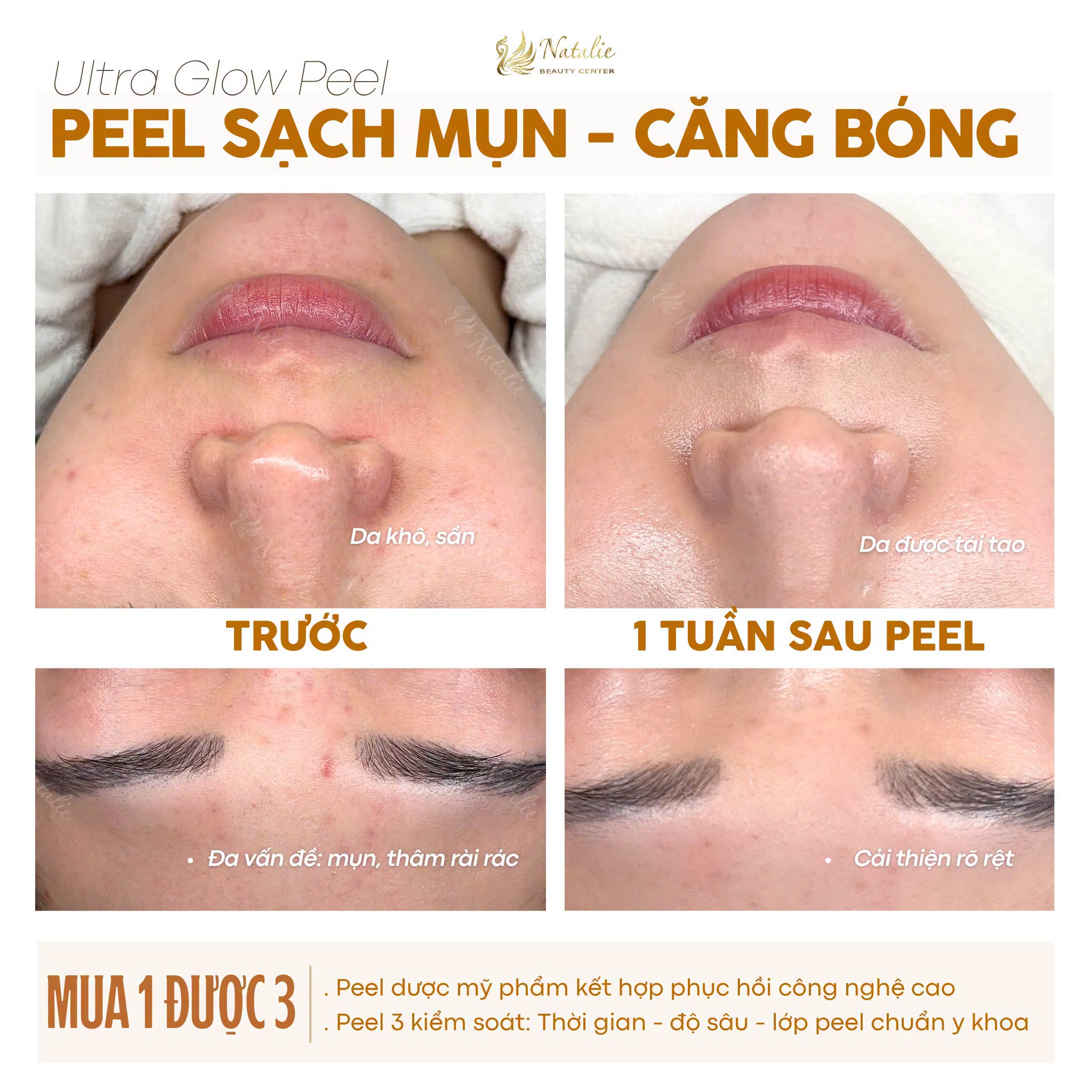 giảm thâm khách na mụn