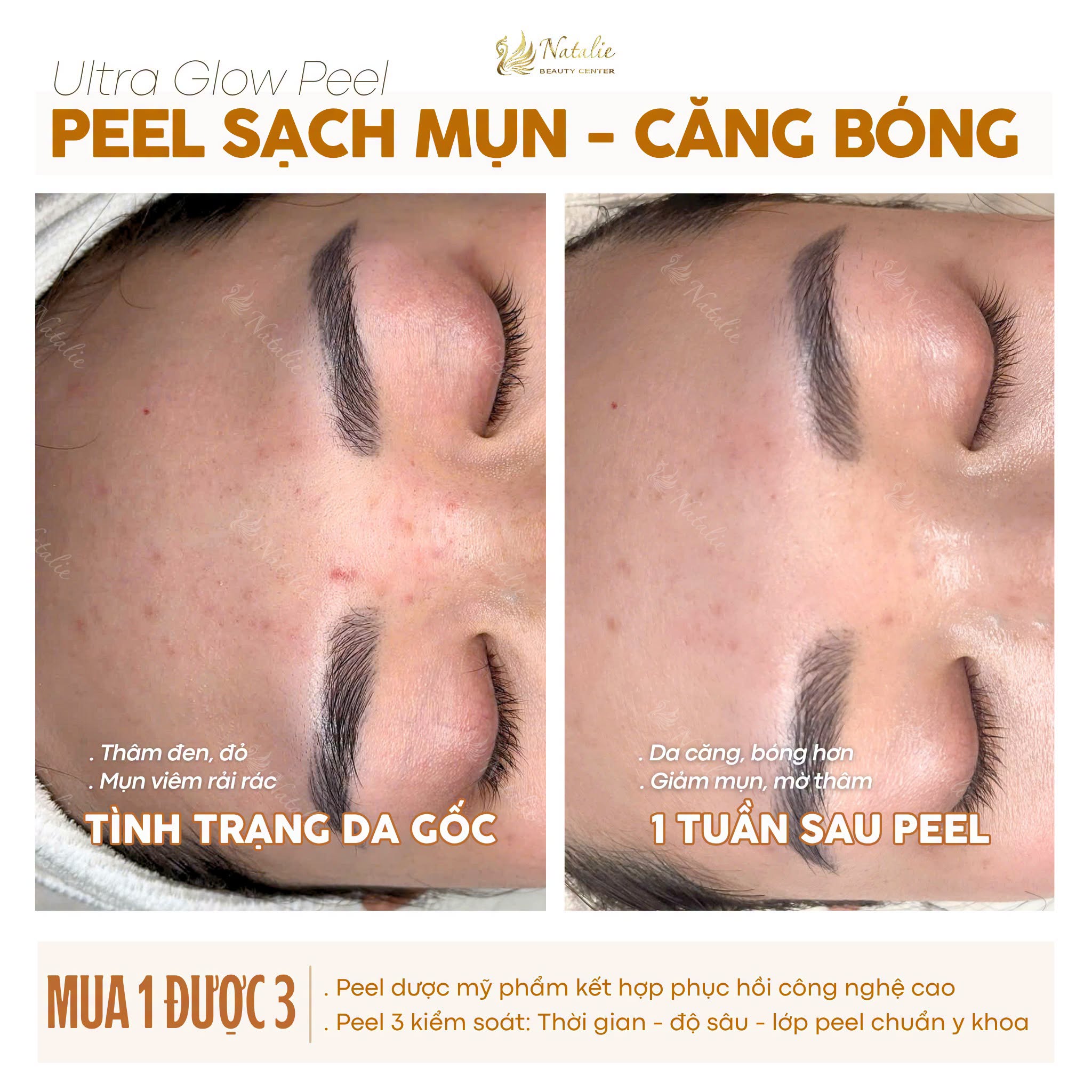 da thâm mụn khách