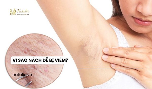 vì sao nách dễ bị viêm