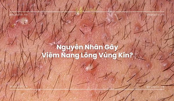 nguyên nhân viêm nang lông bikini