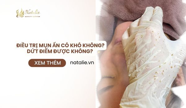 điều trị mụn ẩn có khó không