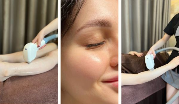 triệt lông giảm lỗ chân lông