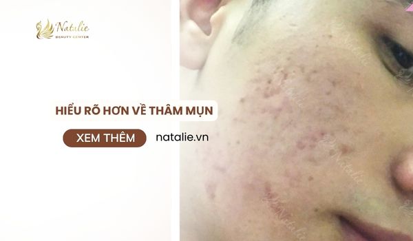 hiểu rõ hơn về vết thâm mụn