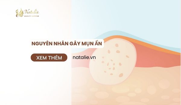 nguyên nhân mụn ẩn