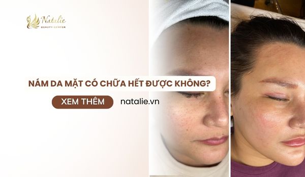 nám da mặt chữa hết không