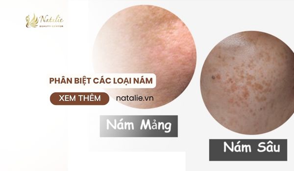 phân biệt các loại nám