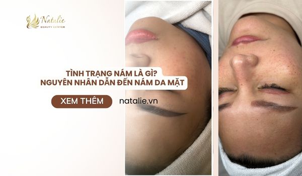 nguyên nhân nám da mặt