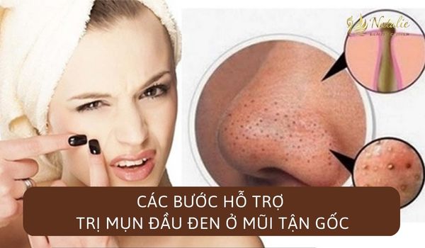 các bước hỗ trợ trị mụn đầu đen