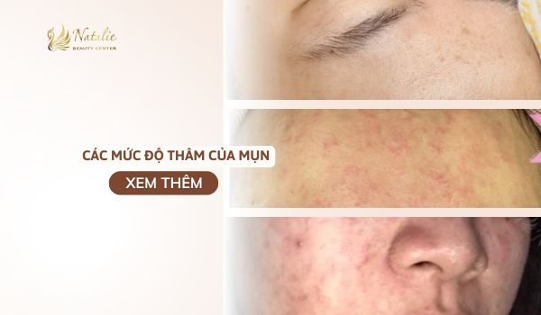 mức độ thâm