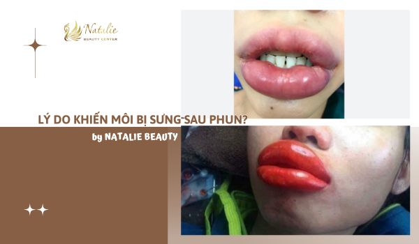 lý do sưng sau phun