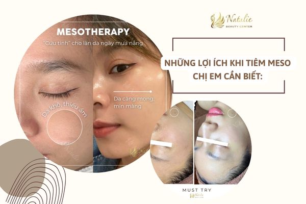 lợi ích meso