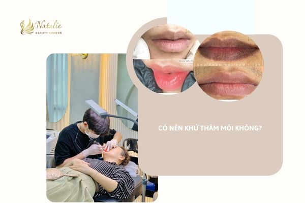 có nên khử thâm môi hay không