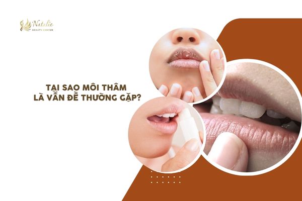 tại sao môi thâm phổ biến