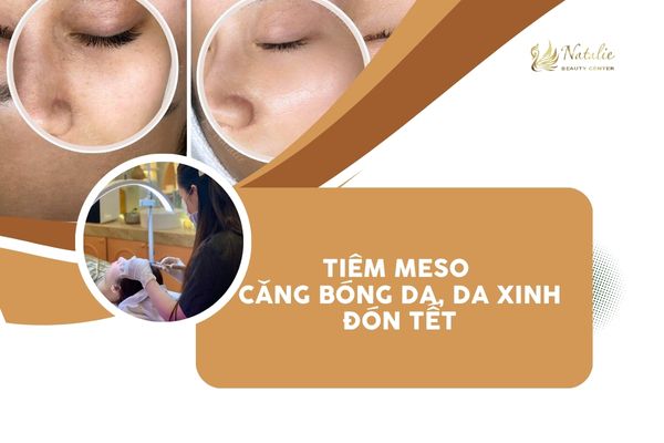 tiêm meso da căng đón tết