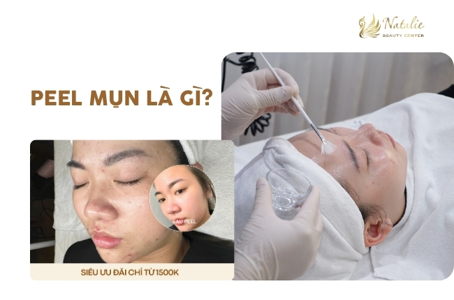 tìm hiểu peel mụn là gì