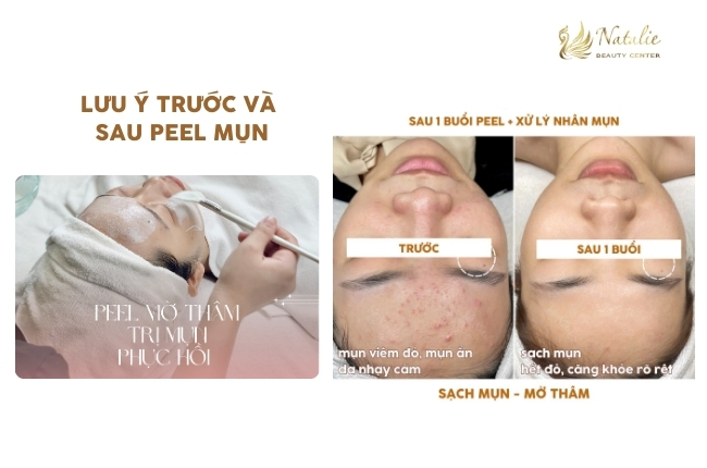 lưu ý trước sau peel
