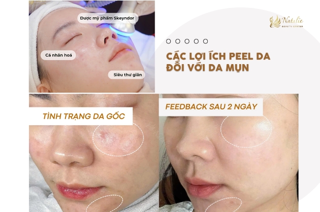 lợi ích peel da