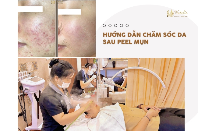 hướng dẫn chăm sau peel