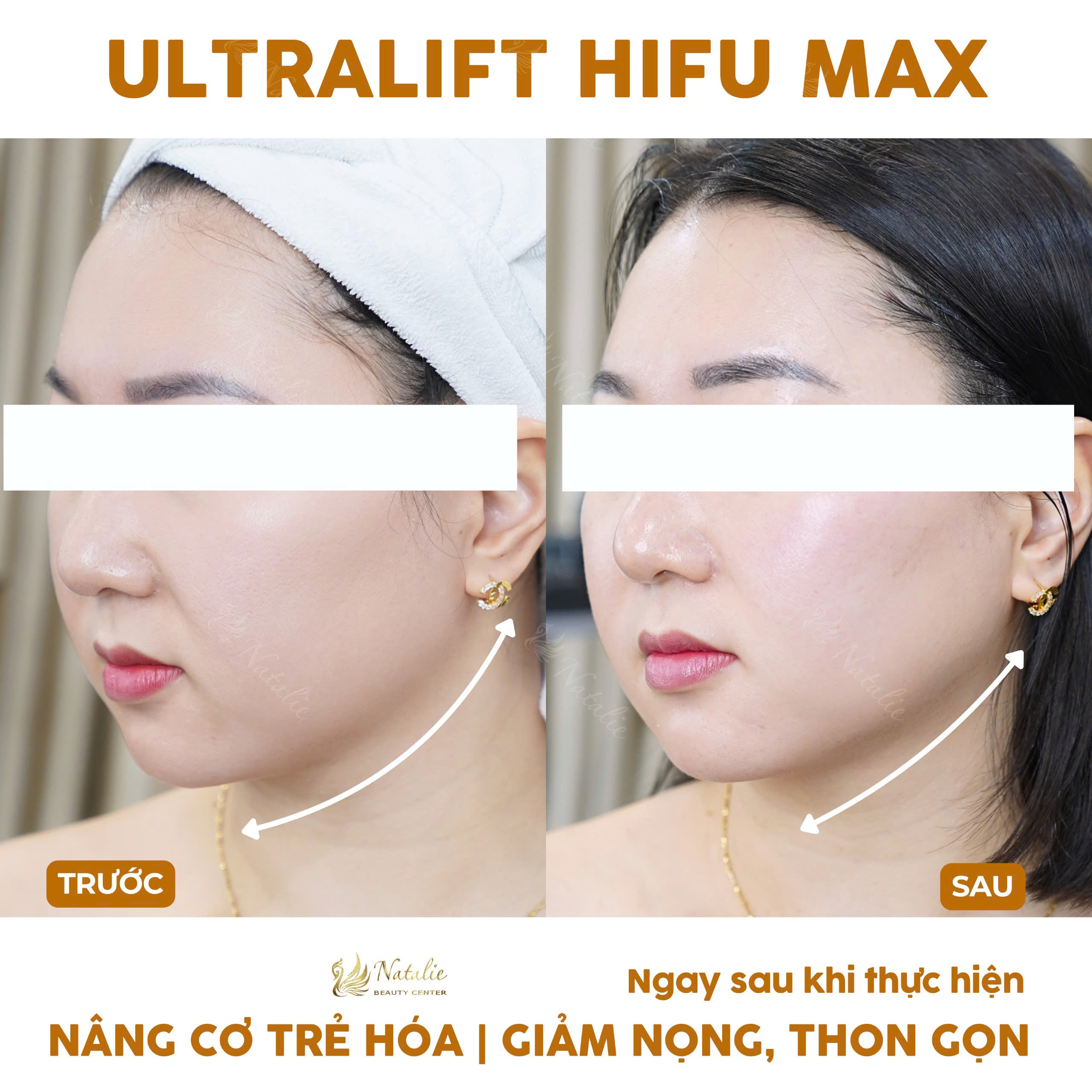hifu1