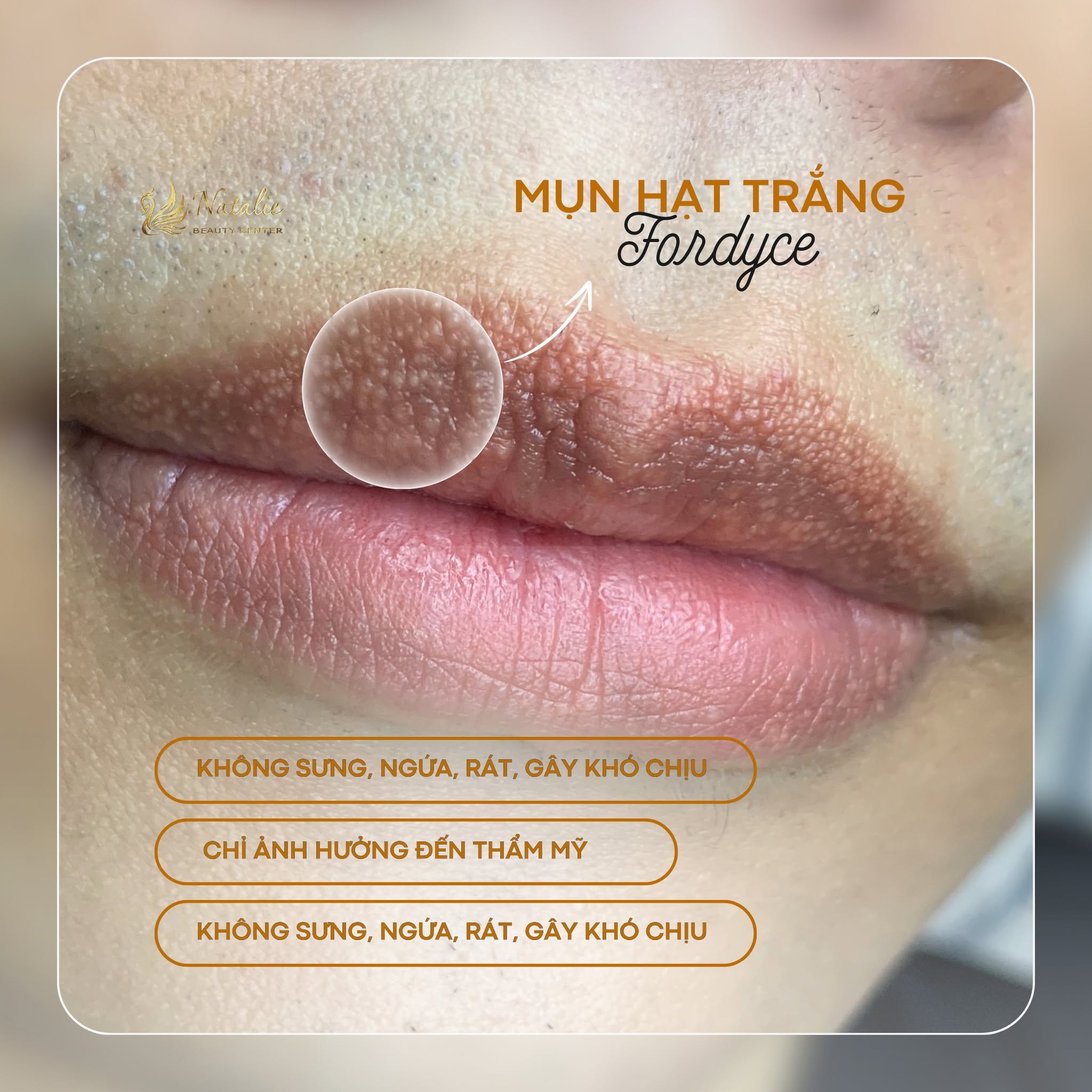 dấu hiệu bị herpes