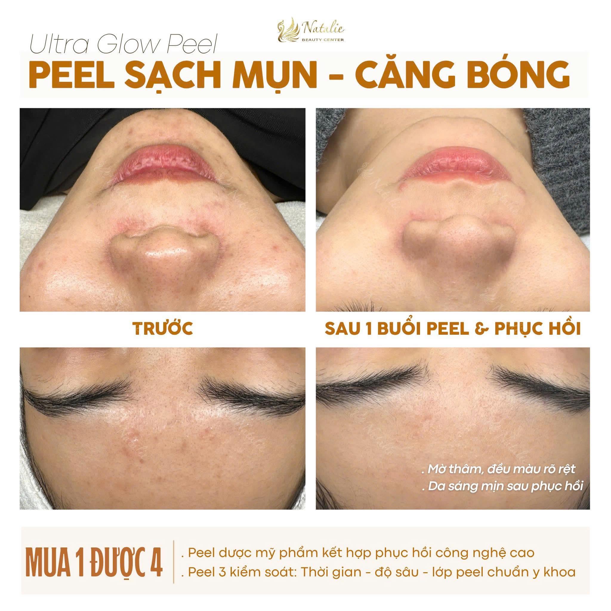 peel mụn da mịn