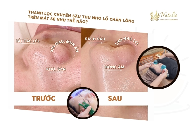 thanh lọc da