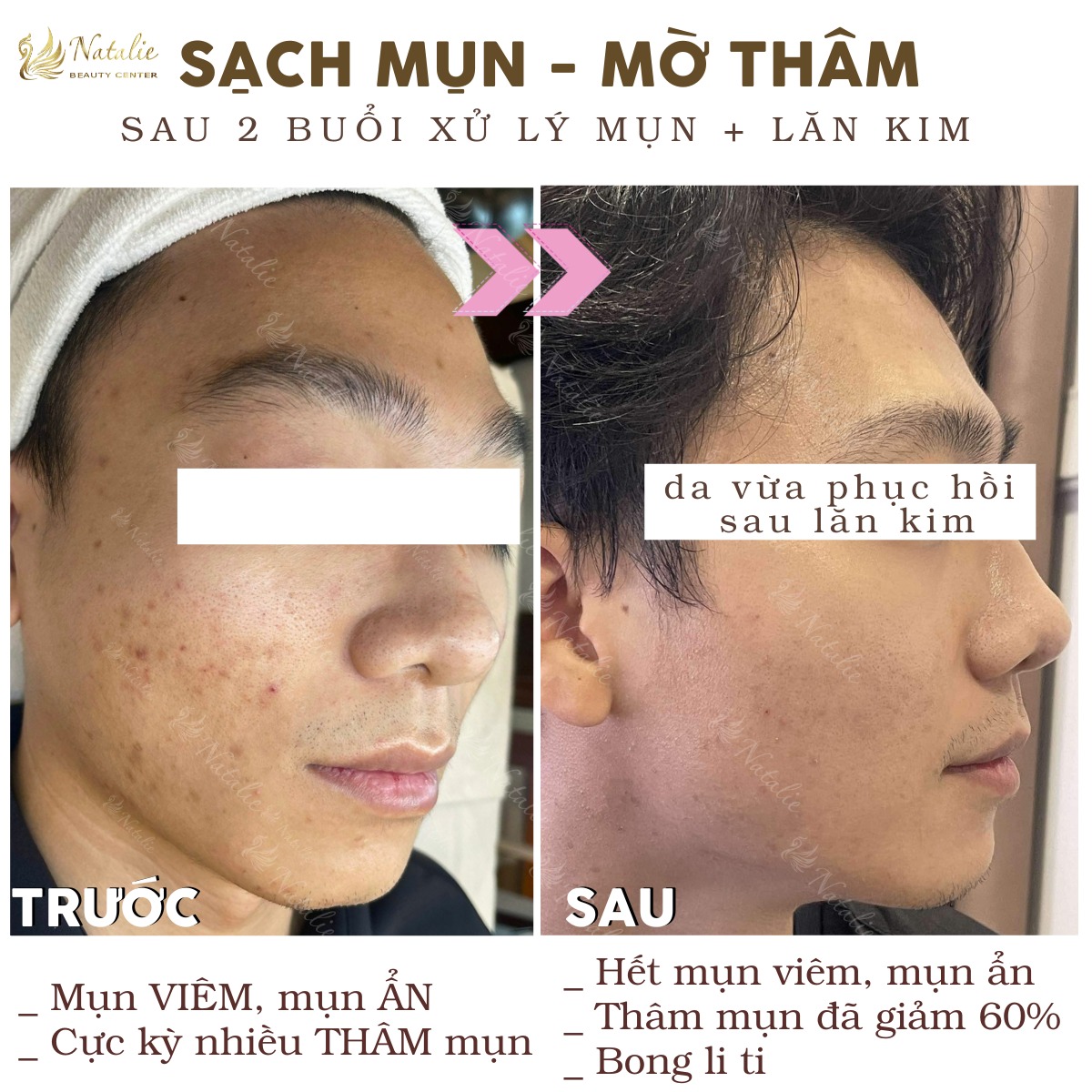 mờ thâm bốn