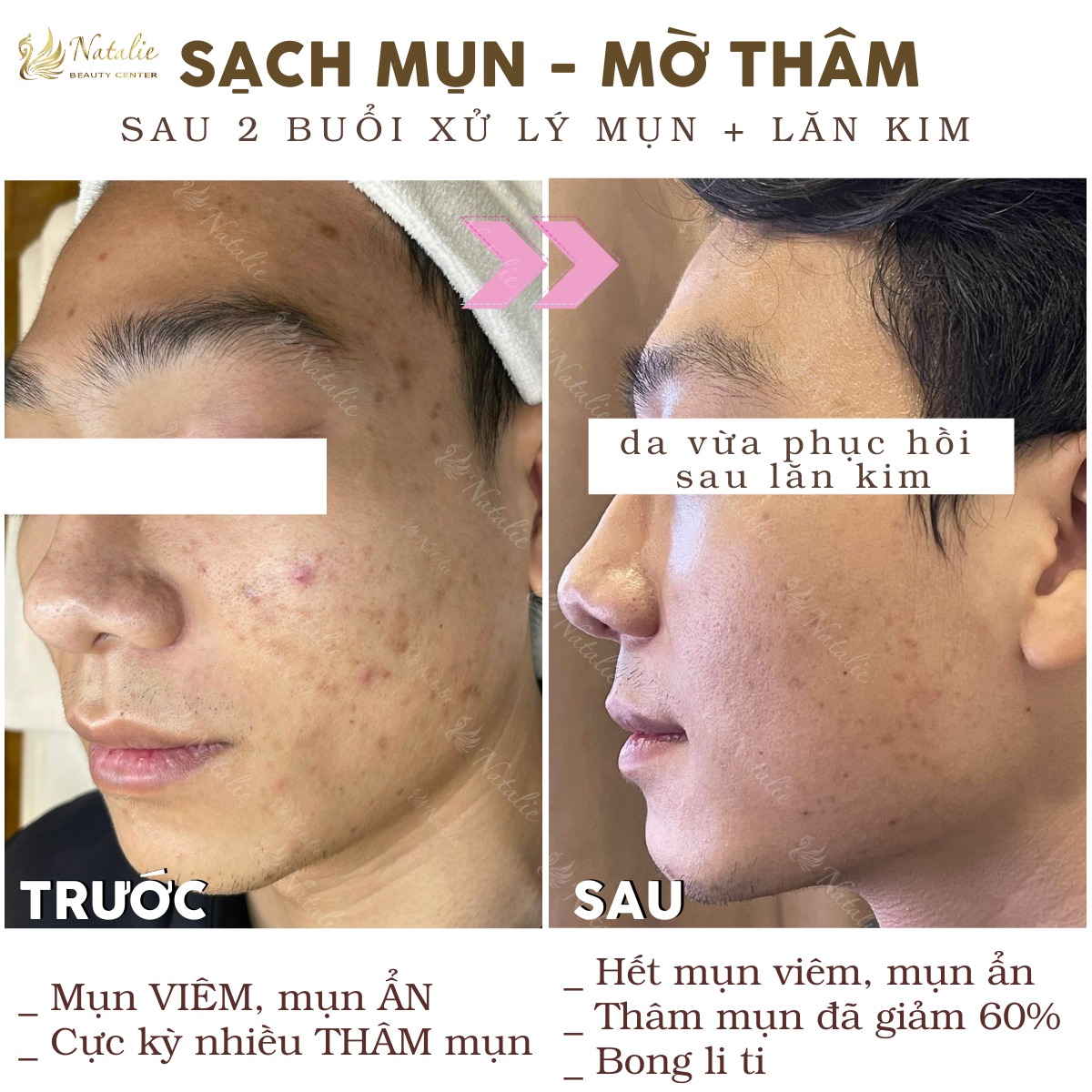 mờ thâm ba