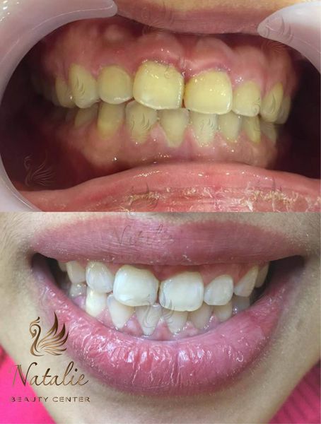 tẩy trắng răng tại Na