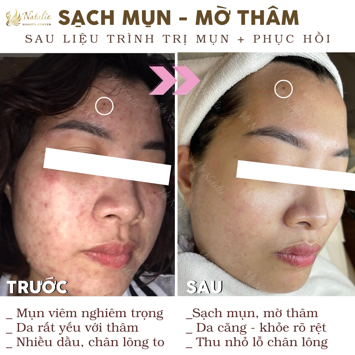 mờ thâm một