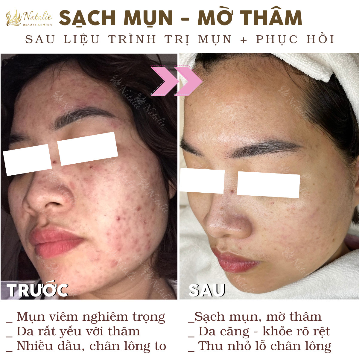 mờ thâm hai