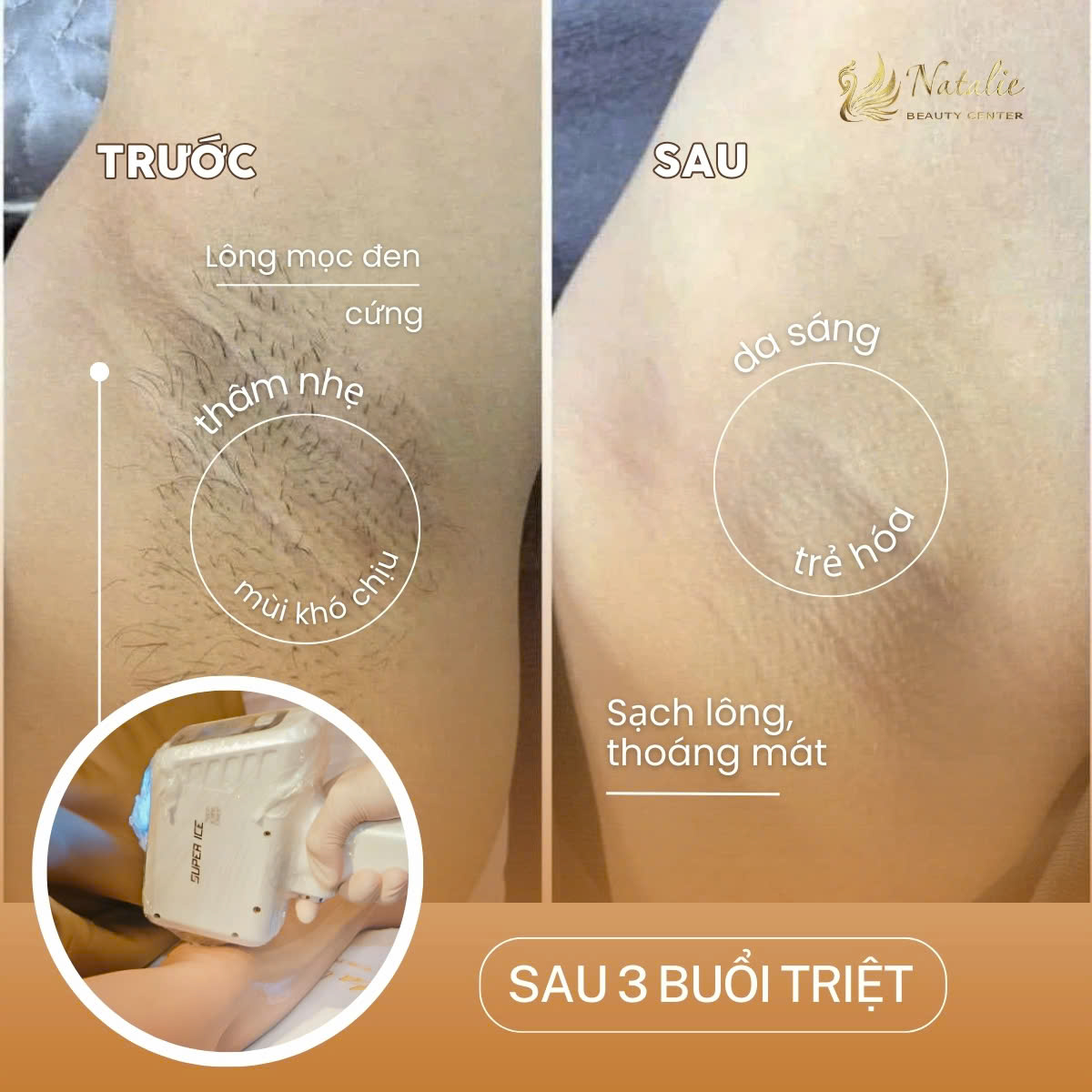 Triệt lông hiệu quả