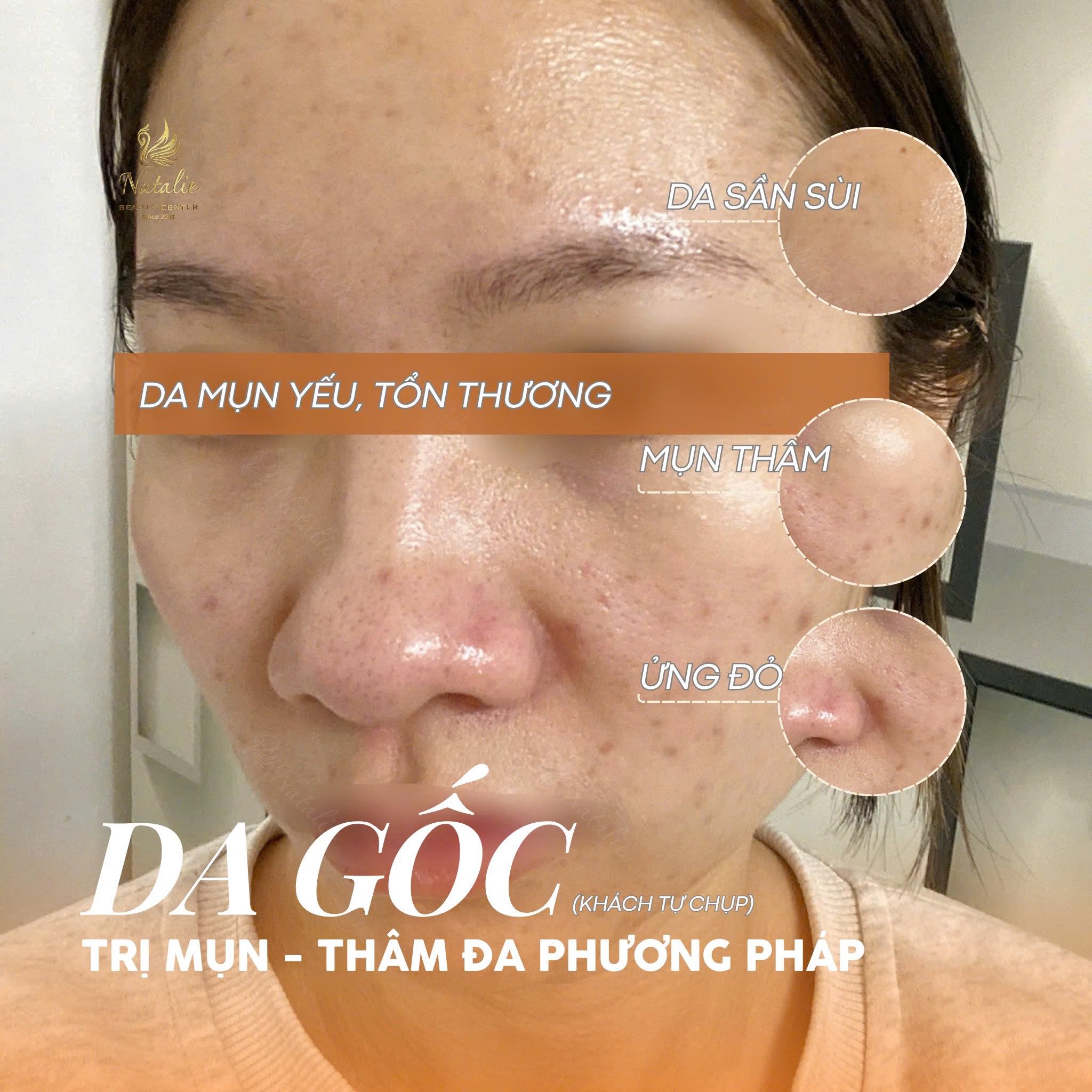 Triệt lông hiệu quả