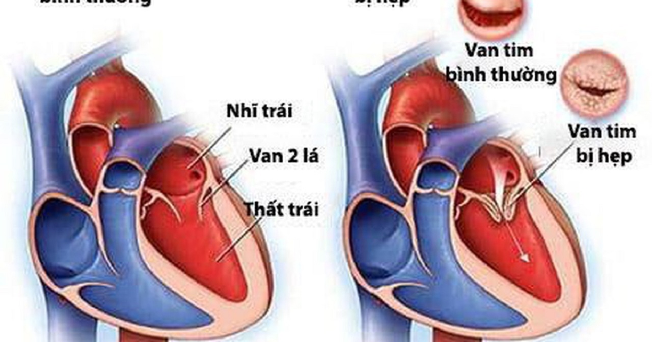 benh-hep-van-tim