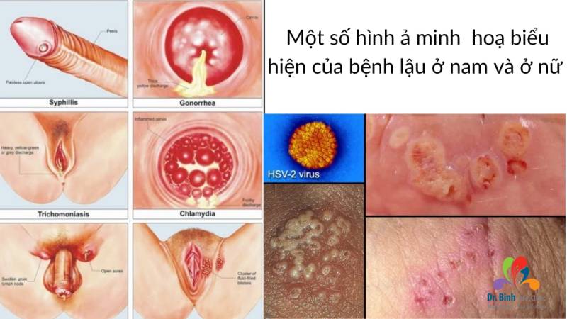 Bệnh lậu, một trong các bệnh lây qua đường tình dục phổ biến cả nam và nữ giới