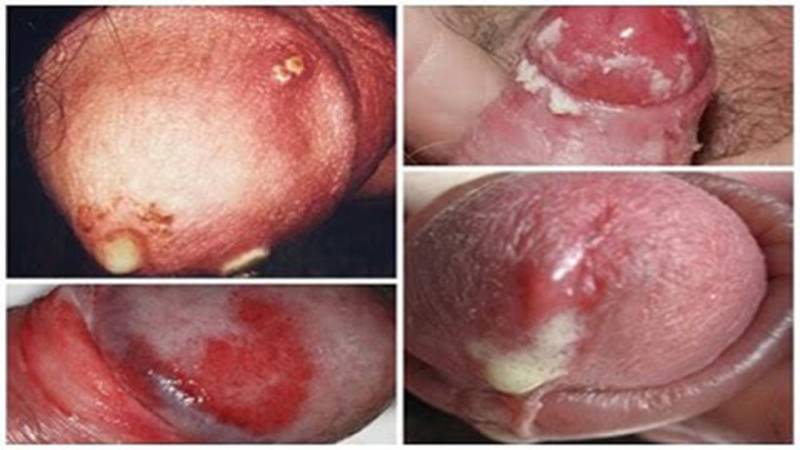 Biểu hiện bệnh lậu ở nam giới dễ phát hiện sau thời gian ủ bệnh