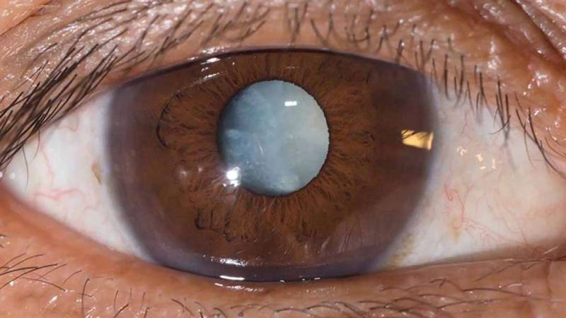 Hình ảnh mắt bị hội chứng tăng nhãn áp góc mở giai đoạn nặng