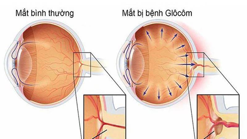 Dấu hiệu bệnh tăng nhãn áp ở mắt người so sánh với mắt thường