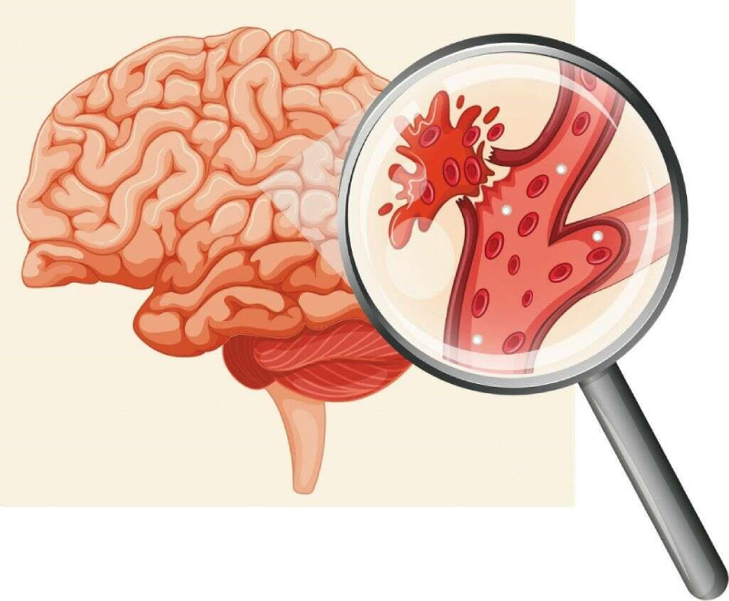 Tình trang tai biến mạch máu não (đột quỵ) đang có xu hương bị trẻ hóa do nhiều nguyên nhân từ người trẻ tuổi