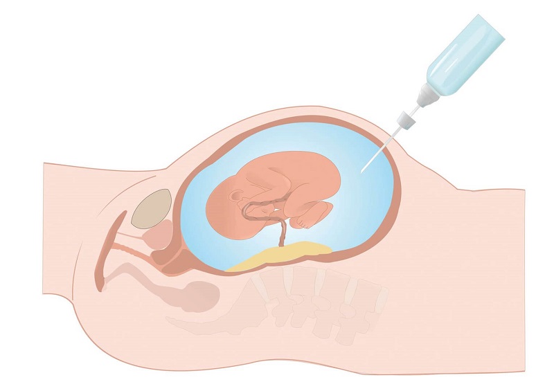Phương pháp sàng lọc trước sinh Double Test có khả năng phát hiện nguy cơ dị tật bẩm sinh ở thai nhi