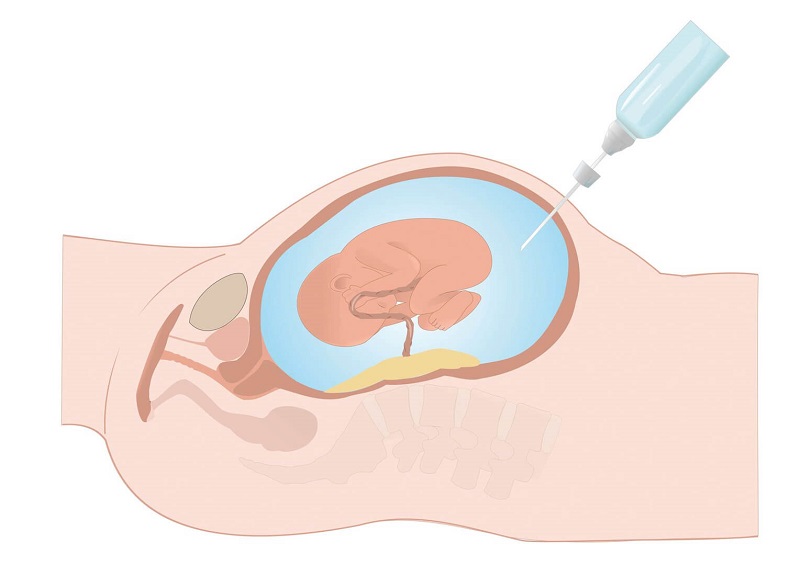 Thai phụ sẽ phải làm thêm các phương pháp như siêu âm, chọc ối hoặc sinh thiết để đảm bảo kết quả chẩn đoán được chính xác nhất. 