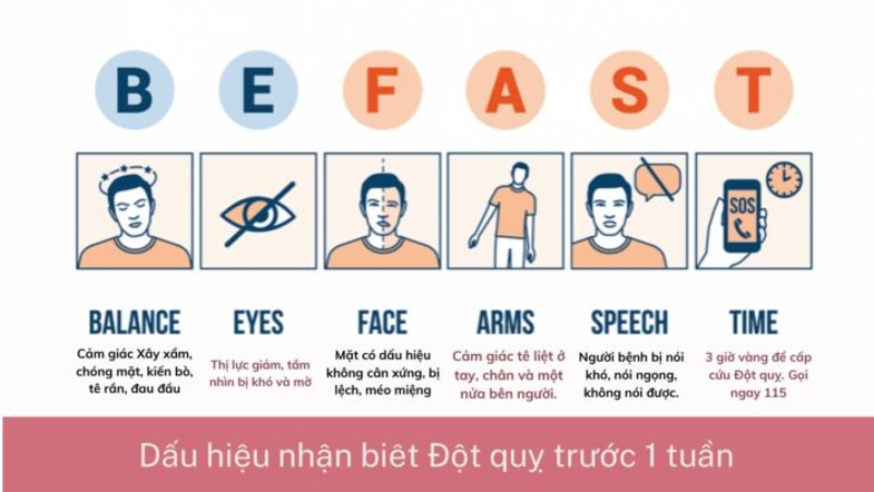 Nguyên tắc BE FAST phát hiện dấu hiệu đột quỵ sớm được nhân viên y tế áp dụng