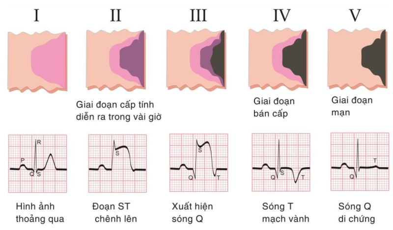 tTêu chuẩn chân đoán nhồi máu cơ tim trên ECG