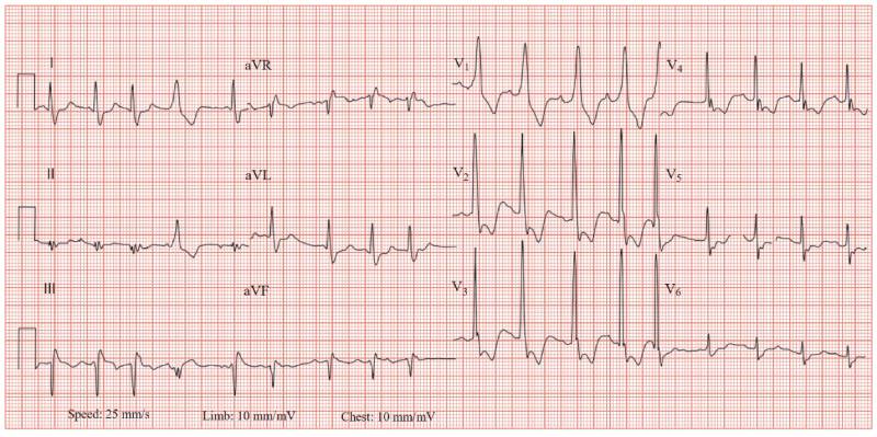 Phát hiện nhồi máu cơ tim qua các triệu chứng và dấu hiệu trên điện tâm đồ (ecg)